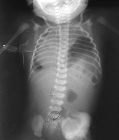 Cong Absence Diaphragm